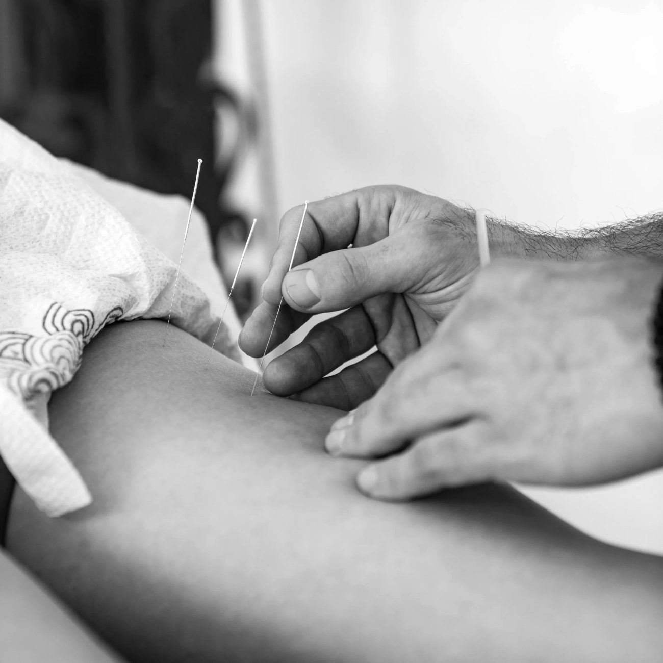 Dry needling treatment