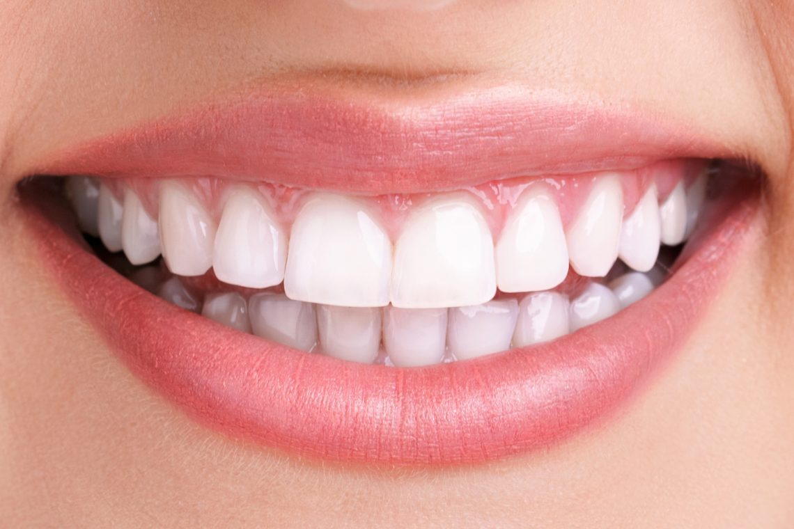 Teeth after professional whitening — noticeably brighter
