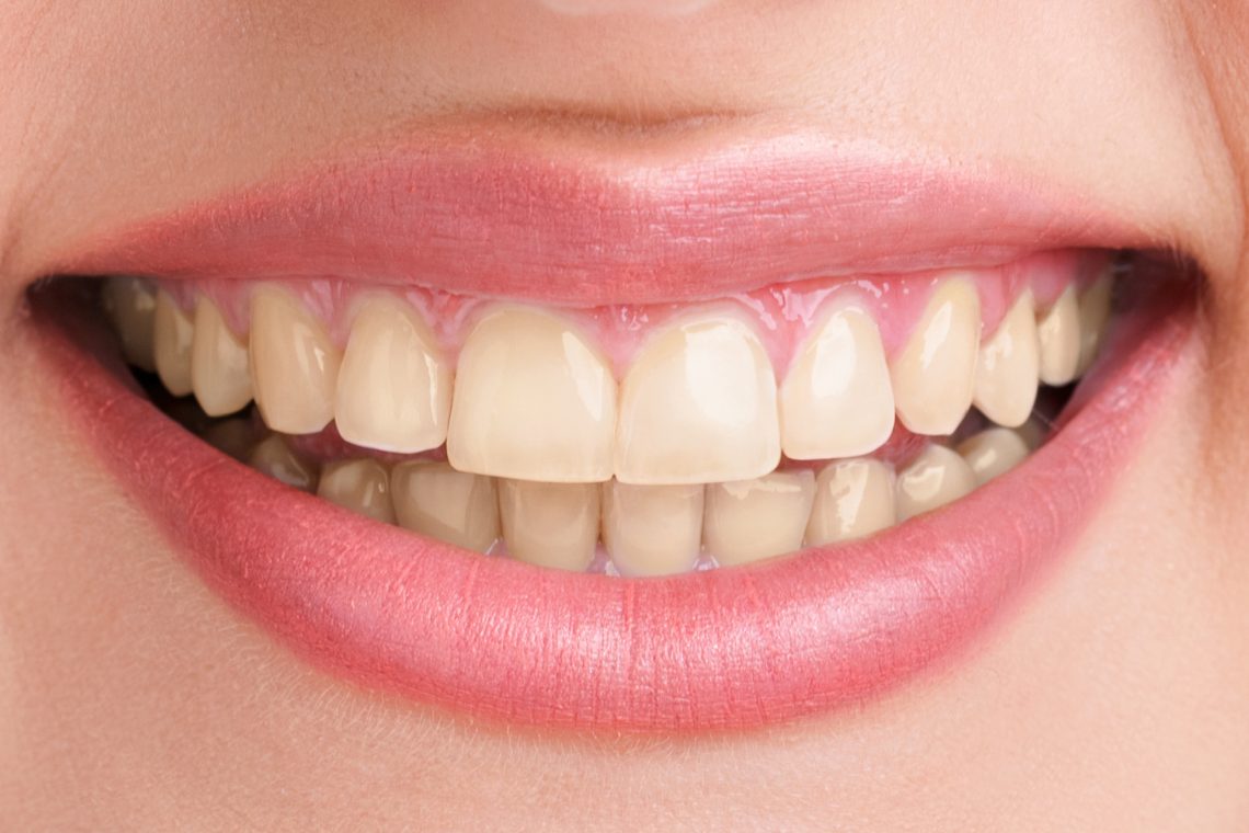 Teeth before whitening — natural staining